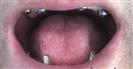 Dental Implants - West Dental Clinic