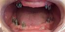 Dental Implants - West Dental Clinic