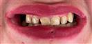 Dental Implants - West Dental Clinic