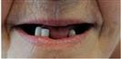 Dental Implants - West Dental Clinic