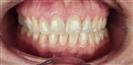 Dental Implants - West Dental Clinic