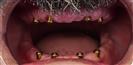 Dental Implants - West Dental Clinic