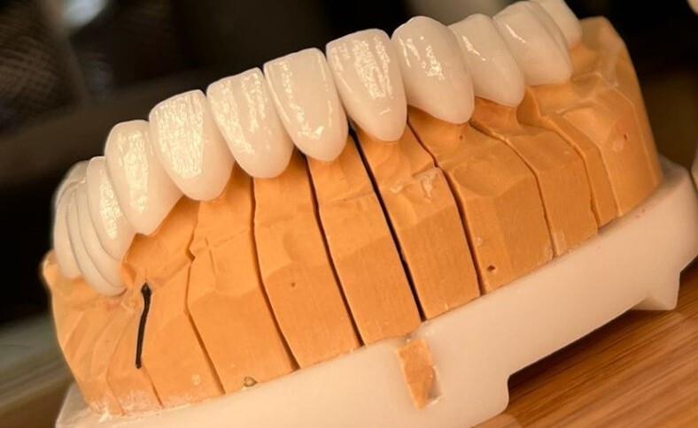 Zirconium Crown - West Dental Clinic