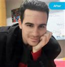 FUE Hair Transplant - Vera Clinic