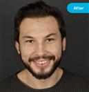 FUE Hair Transplant - Vera Clinic