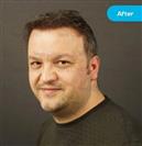 FUE Hair Transplant - Vera Clinic