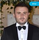 FUE Hair Transplant - Vera Clinic