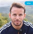 FUE Transplant - Vera Clinic