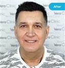FUE Hair Transplant - Vera Clinic