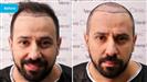 FUE Hair Transplant - Vera Clinic