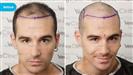 FUE Hair Transplant - Vera Clinic