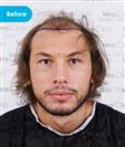 FUE Hair Transplant - Vera Clinic