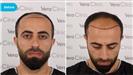 FUE Hair Transplant - Vera Clinic