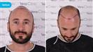FUE Hair Transplant - Vera Clinic