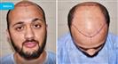 FUE Hair Transplant - Vera Clinic