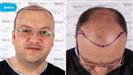 FUE Hair Transplant - Vera Clinic