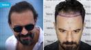 FUE Hair Transplant - Vera Clinic