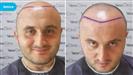 FUE Hair Transplant - Vera Clinic