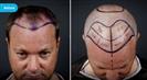 FUE Hair Transplant - Vera Clinic