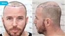 FUE Transplant - Vera Clinic