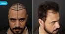 FUE Hair Transplant - Vera Clinic