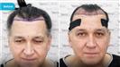 FUE Hair Transplant - Vera Clinic