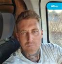 FUE Hair Transplant - Vera Clinic