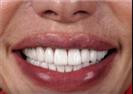 Porcelain Veneers - Vera Clinic