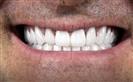 Porcelain Veneers - Vera Clinic