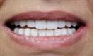 Porcelain Veneers - Vera Clinic