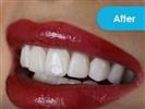 Porcelain Veneers - Vera Clinic