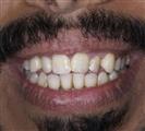 Porcelain Veneers - Vera Clinic