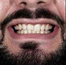 Porcelain Veneers - Vera Clinic