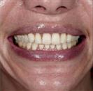 Porcelain Veneers - Vera Clinic