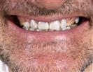 Porcelain Veneers - Vera Clinic