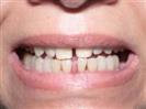 Porcelain Veneers - Vera Clinic
