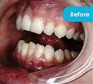 Porcelain Veneers - Vera Clinic