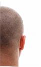FUE Hair Transplant - Cayra Clinic