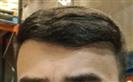 FUE Hair Transplant - Cayra Clinic