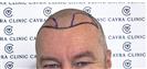 FUE Hair Transplant - Cayra Clinic