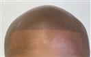 FUE Hair Transplant - Cayra Clinic