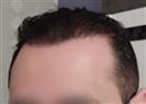 FUE Hair Transplant - Cayra Clinic