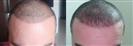 FUE Hair Transplant - Cayra Clinic