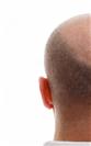 FUE Hair Transplant - Cayra Clinic