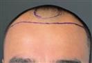 FUE Hair Transplant - Cayra Clinic