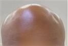 FUE Hair Transplant - Cayra Clinic