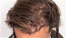 FUE Hair Transplant - Cayra Clinic