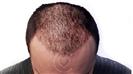 FUE Hair Transplant - Cayra Clinic