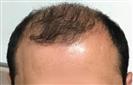 FUE Hair Transplant - Cayra Clinic