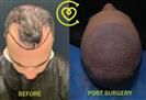 FUE Hair Transplant - Cayra Clinic